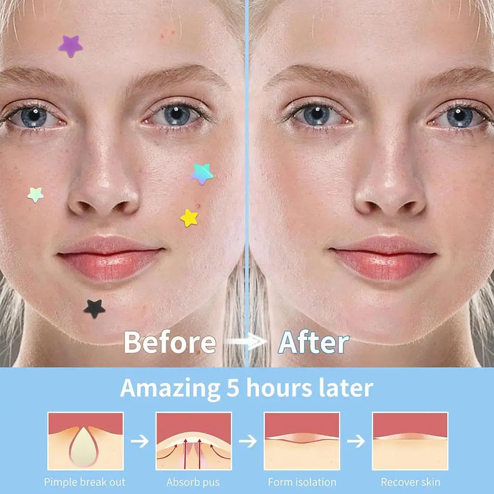 Colorful Star Pimple Patch – Acne Spot Concealer Stickers