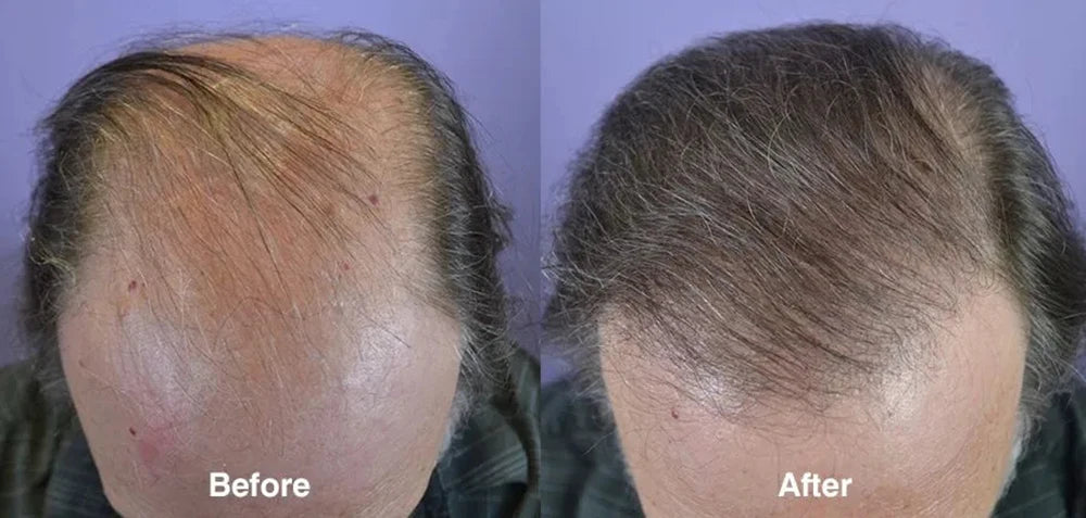 Ginger Hair Care Oil Hair Roots Scalp Treatment Improve Androgenetic Alopecia Scalp Treatment Serum Strengthen Hair Roots