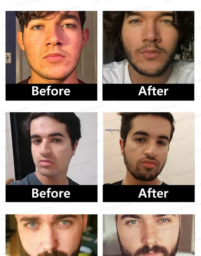 2025 Beard Growth Essence – Fast Hair Growth for Beard, Chest, Legs & Scalp