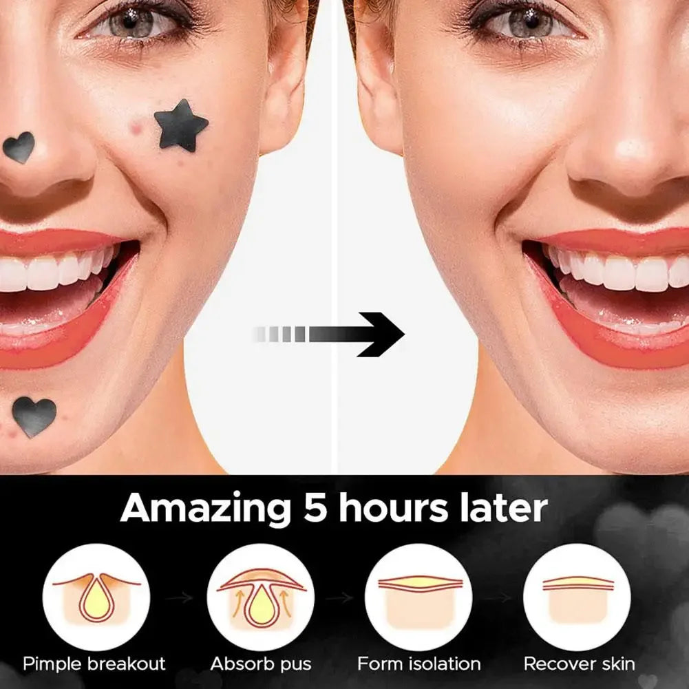 Colorful Star Pimple Patch – Acne Spot Concealer Stickers
