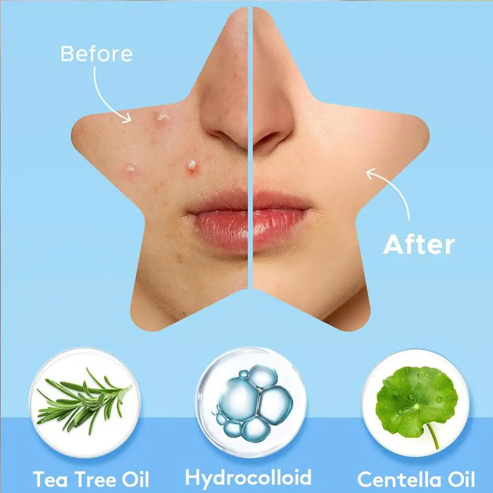 Colorful Star Pimple Patch – Acne Spot Concealer Stickers